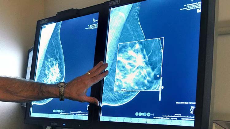 هوش مصنوعی در تشخیص سرطان پستان «به خوبی رادیولوژیست‌ها» عمل می‌کند