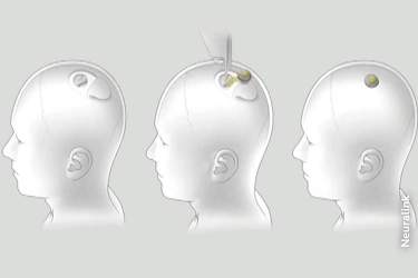 ویدئویی از آغاز فاز آزمایش ایمپلنت مغز بر روی انسان توسط نورالینک