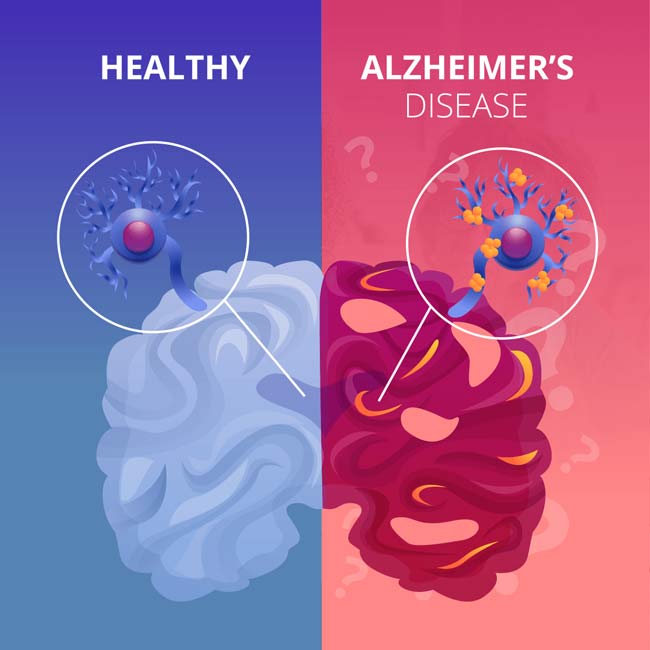 داروی جدیدی علایم آلزایمر را تا ۳۵ درصد کاهش دهد - تی ام گیم