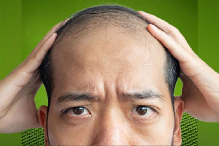جلوگیری از ریزش مو با روغن کندش بهترین توصیه طبیعی برای بهبودی و درمان