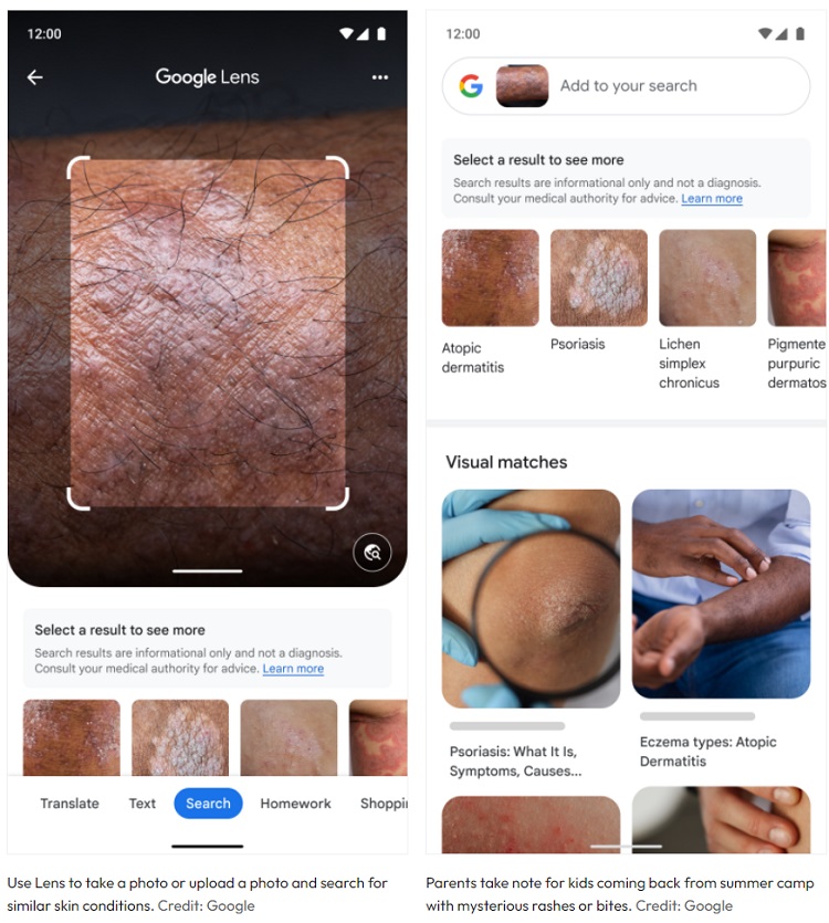 Google Lens uses AI for rash